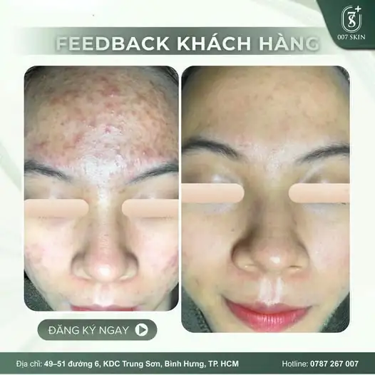 Nhìn lại hành trình thay đổi của vị khách hàng dưới đây, 007 Skin cảm thấy vô cùng hạnh phúc khi được đồng hành cùng bạn trên con đường tìm lại vẻ đẹp tự nhiên.