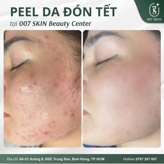 PEEL DA CẢI THIỆN MỤN, SẦN – ĐÓN TẾT TỰ TIN 🌸