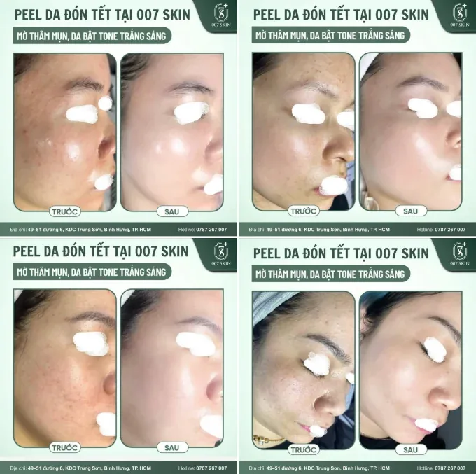 PEEL DA ĐÓN TẾT 2026 – DA ĐẸP RẠNG NGỜI CÙNG 007 SKIN 🎉