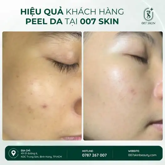 PEEL DA – HỖ TRỢ GIẢM THÂM MỤN, DA SÁNG VÀ CĂNG BÓNG HƠN ✨