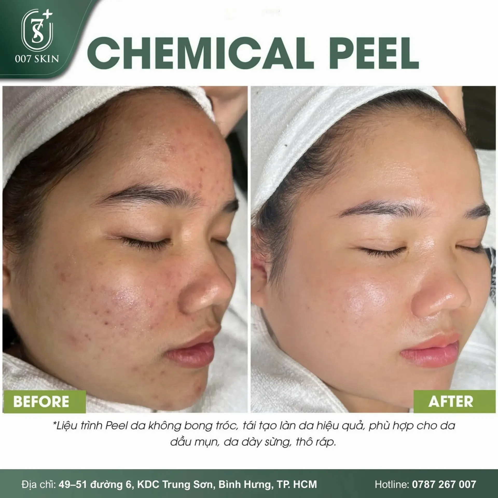 PEEL DA KHÔNG BONG TRÓC – LÀN DA SÁNG MỊN NHƯ GƯƠNG!