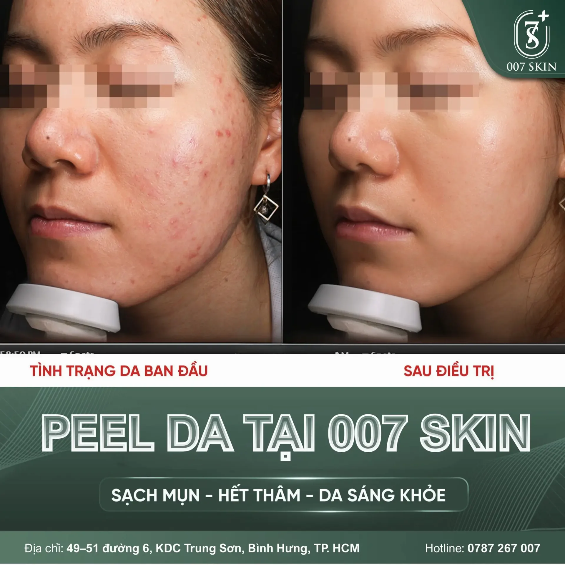 PEEL DA TẠI 007 SKIN: KHÔNG CHỈ LÀ SẠCH MỤN, MÀ LÀ TÁI TẠO LÀN DA MỚI! ✨