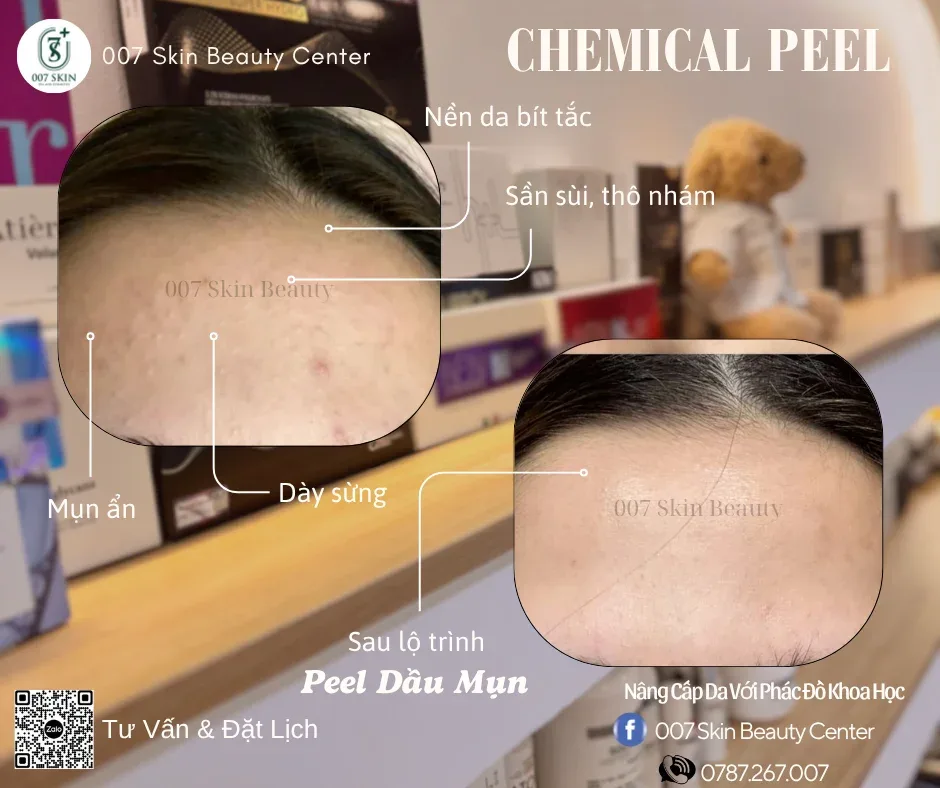 PEEL LÀ GÌ? Giải Mã Tất Tần Tật & Sự Thật Về Việc Peel Có Làm Mỏng Da?