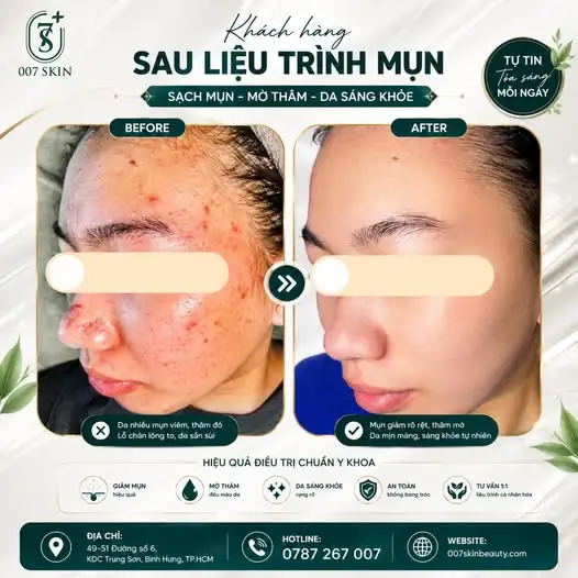 Tự tin tỏa sáng mỗi ngày với làn da sạch mụn - mờ thâm! 🌸