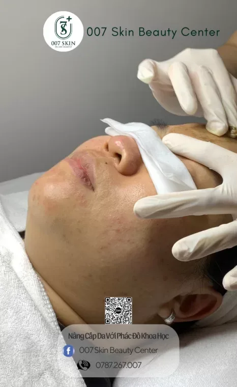 PHYTO PEELING - VI TẢO CANXI