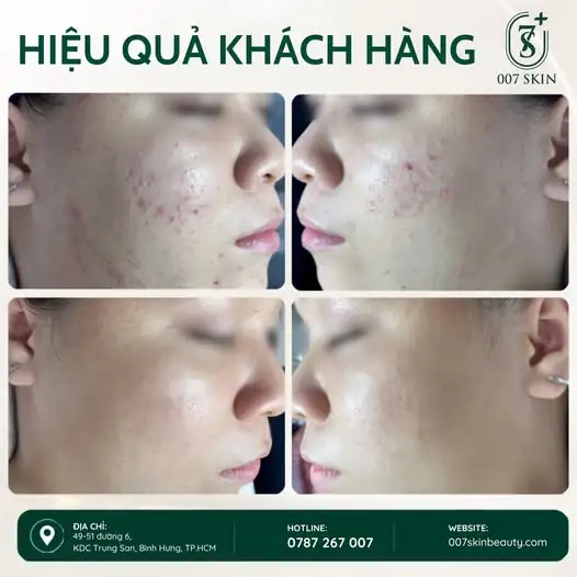 SAU KHI PEEL DA – LÀN DA THAY ĐỔI RÕ RỆT