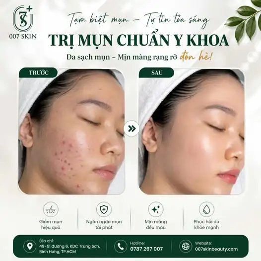 TẠM BIỆT MỤN – CHÀO ĐÓN LÀN DA CĂNG BÓNG ĐÓN HÈ! ☀️