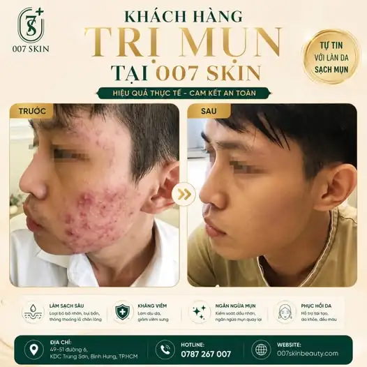 TẠM BIỆT MỤN - ĐÓN DA SÁNG KHỎE MỊN MÀNG ✨