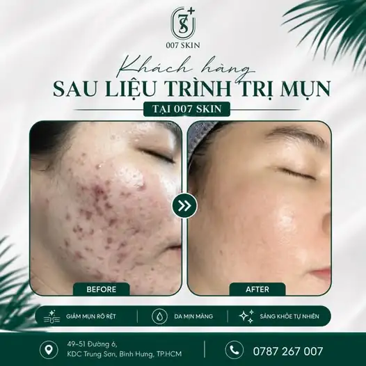 TẠM BIỆT MỤN, ĐÓN LÀN DA MỊN MÀNG CÙNG 007 SKIN! 👋✨