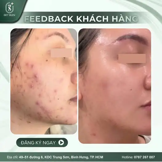 TẠM BIỆT MỤN – LẤY LẠI TỰ TIN TẠI 007 SKIN 🎯