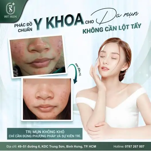 TẠM BIỆT MỤN – LẤY LẠI TỰ TIN VỚI PHÁC ĐỒ Y KHOA ✨