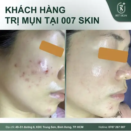TẠM BIỆT MỤN VIÊM - LẤY LẠI LÀN DA CĂNG BÓNG CHỈ SAU MỘT LIỆU TRÌNH! ✨
