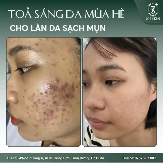 TẠM BIỆT MỤN VIÊM – LẤY LẠI TỰ TIN CHỈ SAU 1 LIỆU TRÌNH! ✨