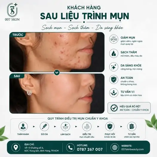Tạm biệt những nốt mụn viêm "đáng ghét", đón làn da láng mịn trở lại! ✨