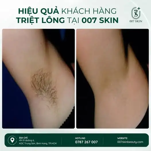 TẠM BIỆT NỖI LO LÔNG NÁCH – ĐÓN LÀN DA MỊN MÀNG