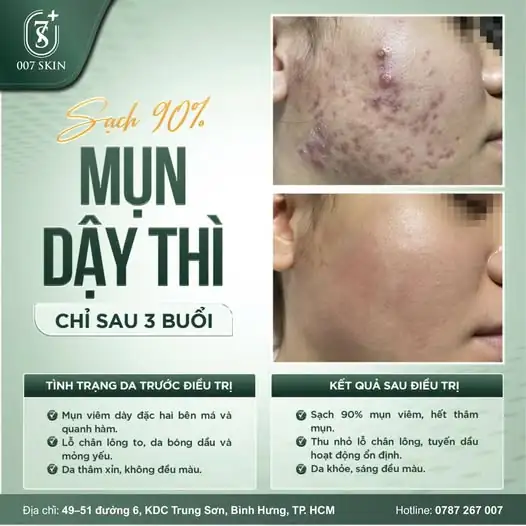TẠM BIỆT NỖI LO MỤN DẬY THÌ – LẤY LẠI TỰ TIN CHỈ SAU 3 BUỔI!