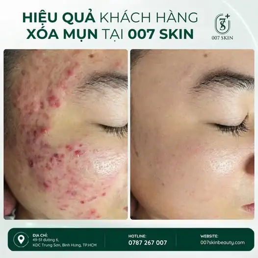 TẠM BIỆT NỖI LO VỀ MỤN – TỰ TIN KHOE LÀN DA 💎