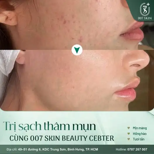 TẠM BIỆT THÂM MỤN – DA MỊN MÀNG, HỒNG HÀO TƯƠI TẮN!