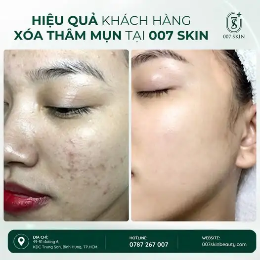THÂM MỤN LÂU NGÀY – ĐỪNG ĐỂ LẠI DẤU VẾT TRÊN LÀN DA!