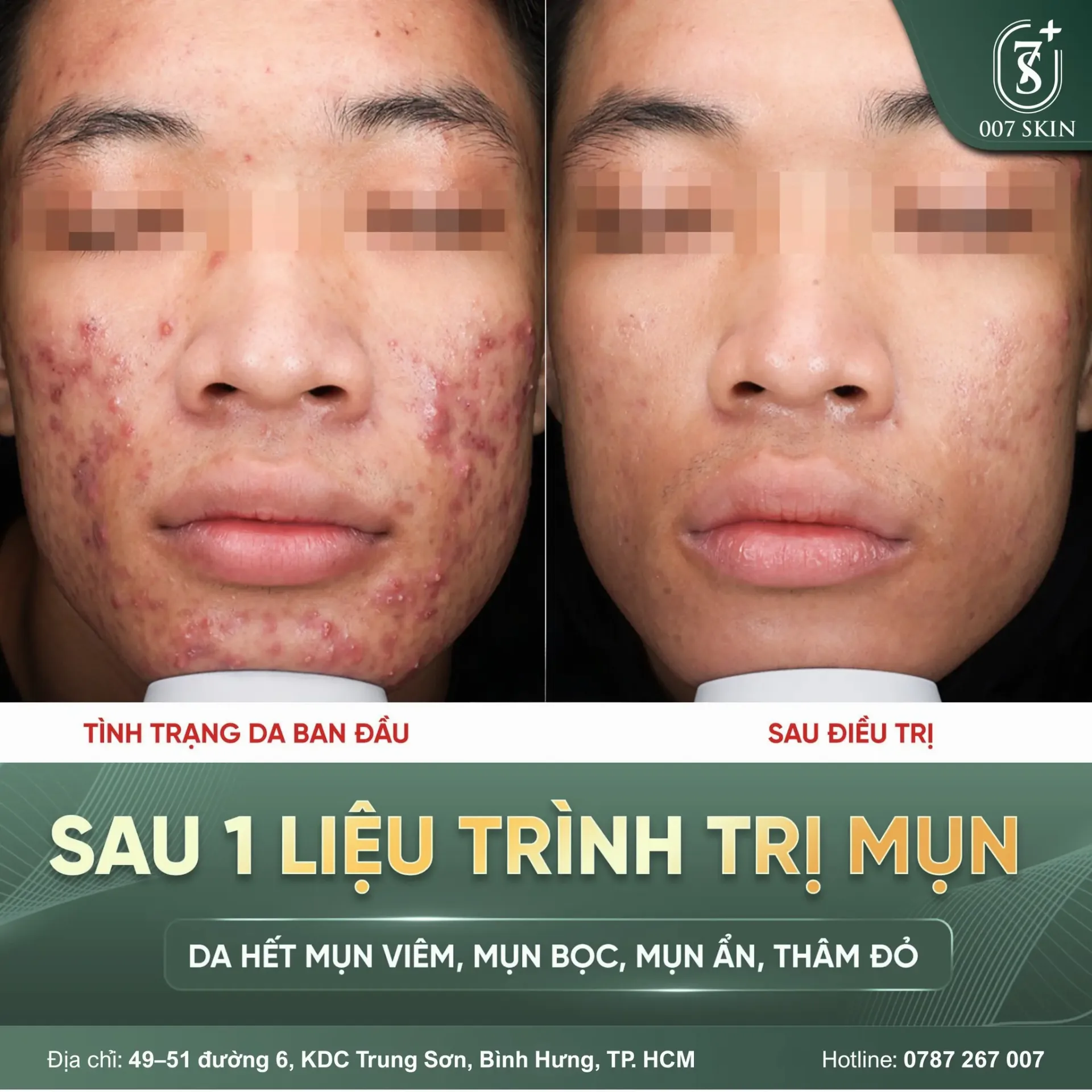 Thay đổi rõ rệt chỉ sau 1 liệu trình trị mụn tại 007 SKIN