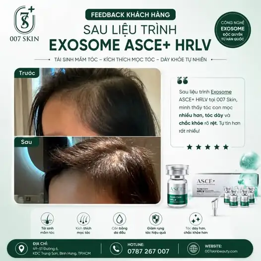 Thực tế từ khách hàng của 007 Skin sau liệu trình Exosome ASCE+ HRLV! 😍