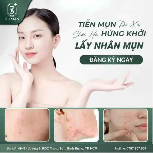 TIỄN MỤN ĐI XA – VUI HÈ HỨNG KHỞI ☀️💦