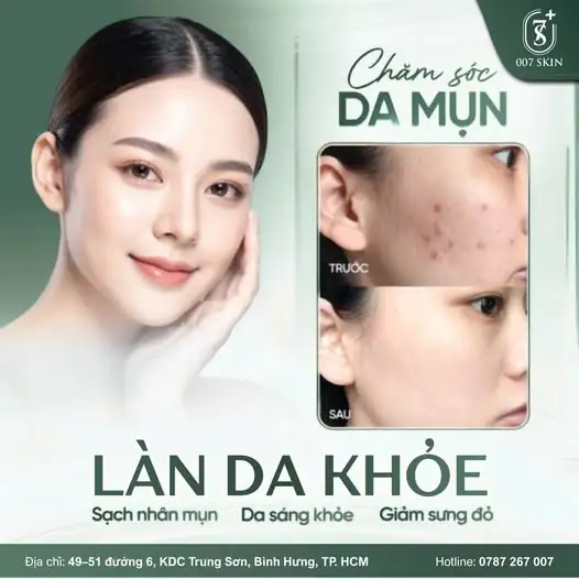 TIÊU DIỆT MỤN – TÁI TẠO LÀN DA KHỎE MẠNH TỪ SÂU BÊN TRONG ✨