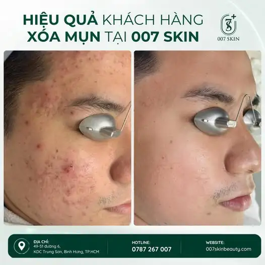TRỊ MỤN ĐÚNG CÁCH – TỰ TIN LÀN DA SẠCH KHỎE ✨