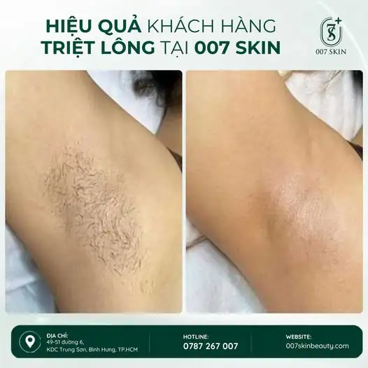 TRIỆT LÔNG NÁCH – TỰ TIN DIỆN ĐỒ, THOẢI MÁI MỖI NGÀY ✨