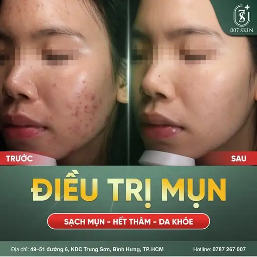 TRƯỚC – SAU ĐIỀU TRỊ MỤN | THAY ĐỔI NHÌN THẤY RÕ