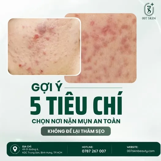 🌿 5 TIÊU CHÍ NHẬN BIẾT LÀN DA MỤN CẦN ĐƯỢC CHĂM SÓC ĐÚNG CÁCH
