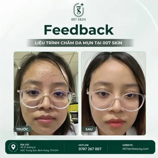 🌿 DA MỤN ĐỪNG LO – ĐÃ CÓ LIỆU TRÌNH CHĂM SÓC DA MỤN CHUYÊN SÂU! 🌿