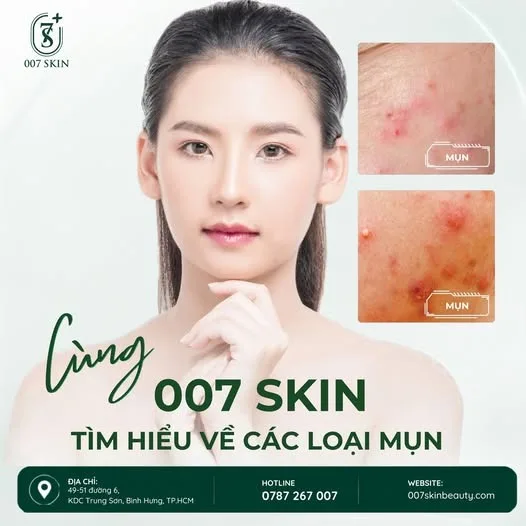 💚 DA MỤN VỐN ĐÃ NHẠY CẢM – ĐỪNG ĐỂ CHĂM SÓC SAI CÁCH KHIẾN DA MỆT MỎI HƠN!
