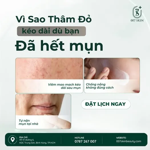 Mụn hết rồi nhưng những vết thâm đỏ vẫn cứ “ở lì” trên da? 😣