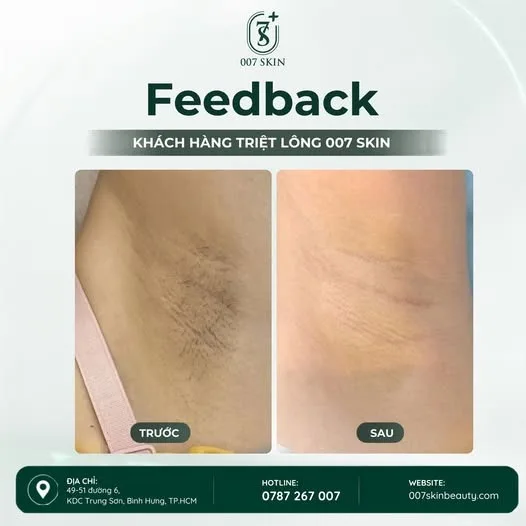 🌷 MUỐN DA MỊN MÀNG, DIỆN GÌ CŨNG XINH? ĐỪNG BỎ QUA TRIỆT LÔNG DIODE LASER! 🌷