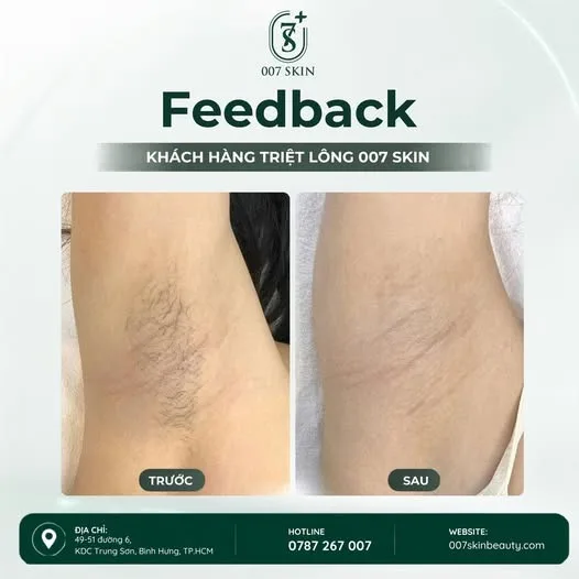 ✨ TRIỆT LÔNG DIODE LASER – DA MỊN MÀNG, TỰ TIN TỎA SÁNG ✨